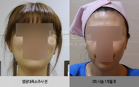 옆광대축소주사 전후사진 입니다 