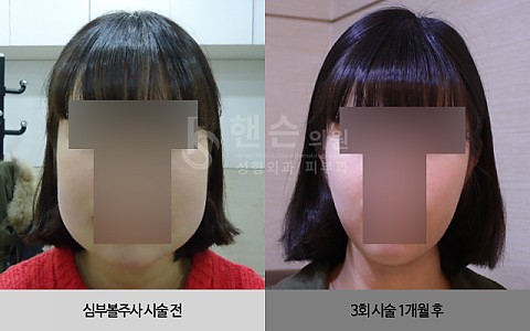 심부볼주사 전후사진입니다. 