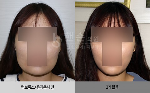 턱보톡스+윤곽주사 전후사진입니다. 