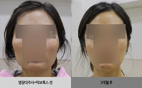 옆광대주사+턱보톡스 전후사진입니다. 