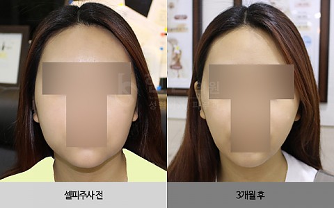 셀피주사 전후사진 입니다. 
