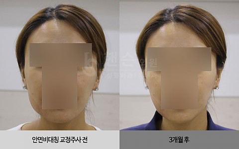 안면비대칭 교정 주사 전후사진입니다. 