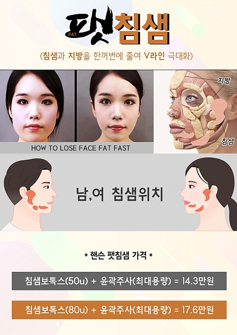 업그레이드된 핸슨의 침샘비대치료 술_팻침샘(날렵한 턱선이 급하신분은 필독!!) 