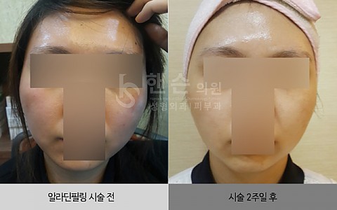 알라딘필링 전후사진 입니다 