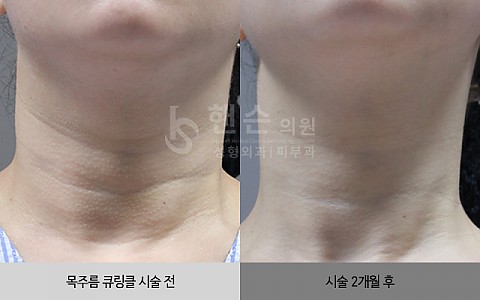 목주름 큐링클주사 시술 전후 사진입니다. 