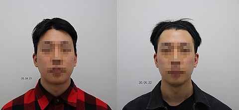 교근 보톡스 후기 (비교사진) . 