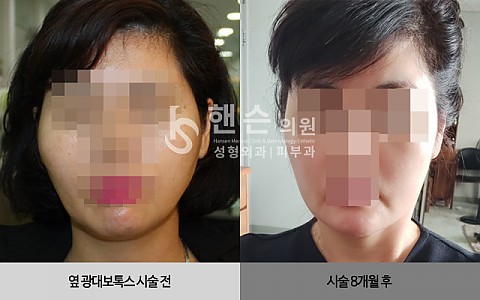 옆광대보톡스 전후사진 입니다. 
