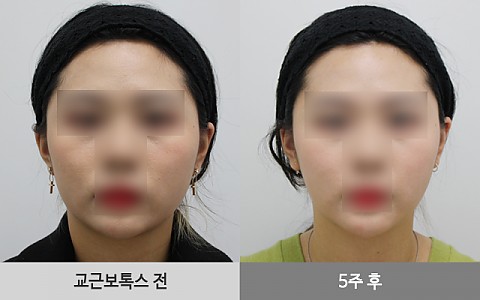 사각턱보톡스(교근보톡스) 전후사진 입니다. 