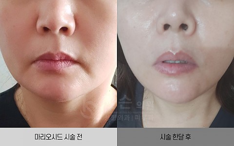 마리오드 시술 전후사진입니다. 