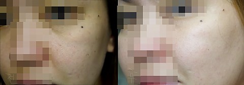 안아픈 아기주사 너무 좋아요ㅠ 