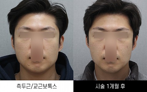 측두근보톡스, 교근보톡스 전후사진입니다. 