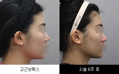 교근보톡스 전후사진입니다. 