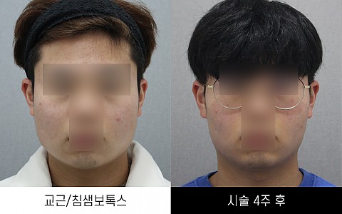 교근/침샘보톡스 전후사진입니다 