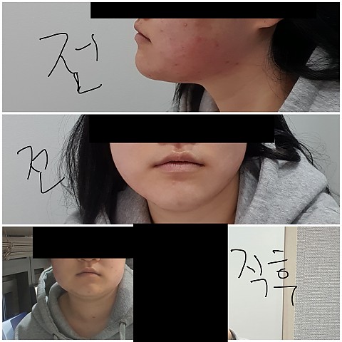 윤곽&보톡스 후기!! 