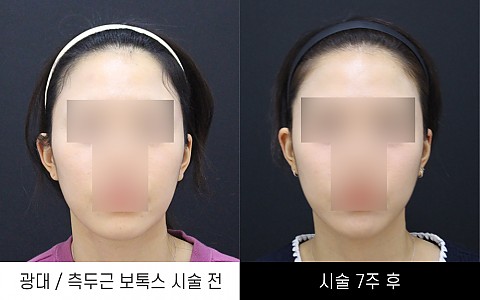 광대보톡스 / 측두근보톡스 전후사진입니다. 