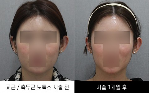 교근보톡스 / 측두근보톡스 전후사진입니다. 