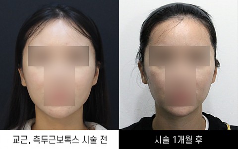 교근보톡스 / 측두근보톡스 전후사진입니다. 