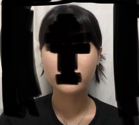 광대&교근 보톡스 후기 