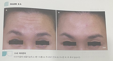 얼굴 주름 피부노화외에도 원인은 다양하다_이마주름 
