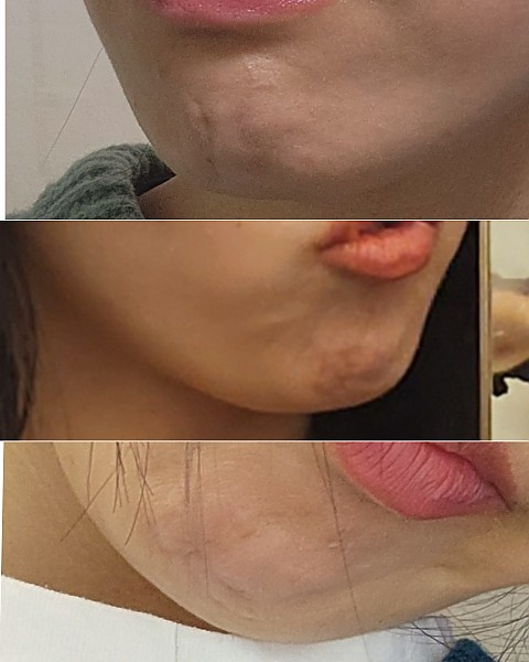 자갈턱 보톡스 후기 