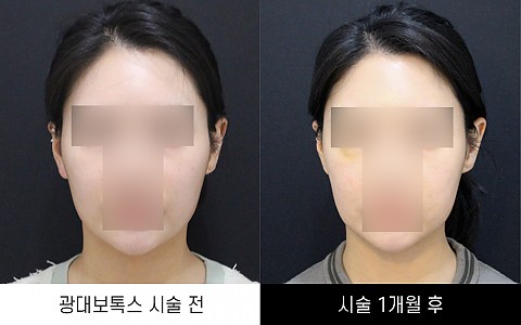 광대보톡스 전후사진입니다. 