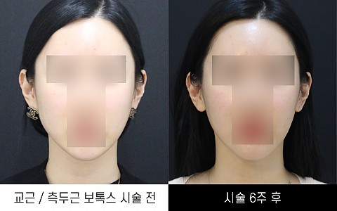 교근보톡스, 측두근보톡스 전후사진입니다. 