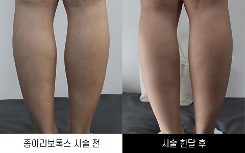 종아리보톡스 전후사진 입니다. 