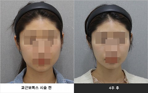 사각턱보톡스 시술 전 후 사진입니다 