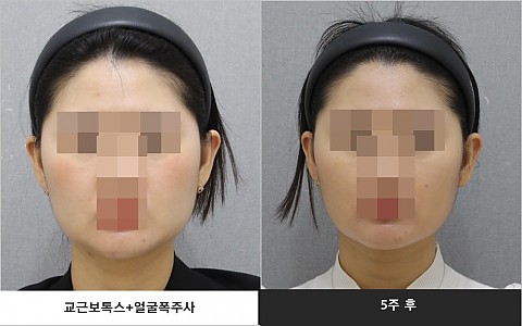 사각턱보톡스 얼굴폭주사 전 후 사진입니다 