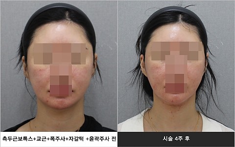 측두근보톡스 윤곽주사 폭주사 사각턱보톡스 시술 전 후 사진입니다 